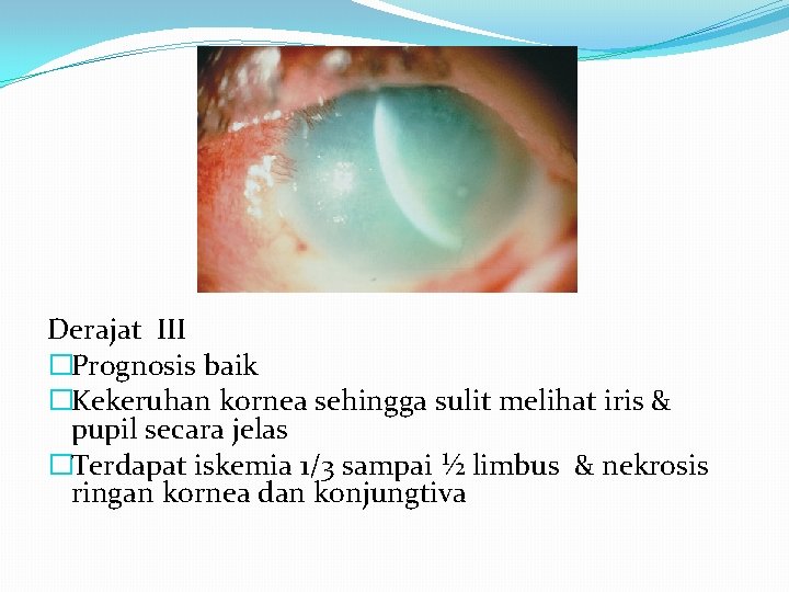 Derajat III �Prognosis baik �Kekeruhan kornea sehingga sulit melihat iris & pupil secara jelas