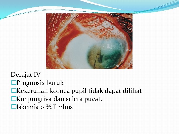 Derajat IV �Prognosis buruk �Kekeruhan kornea pupil tidak dapat dilihat �Konjungtiva dan sclera pucat.