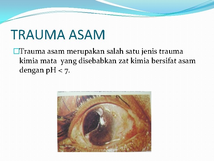 TRAUMA ASAM �Trauma asam merupakan salah satu jenis trauma kimia mata yang disebabkan zat