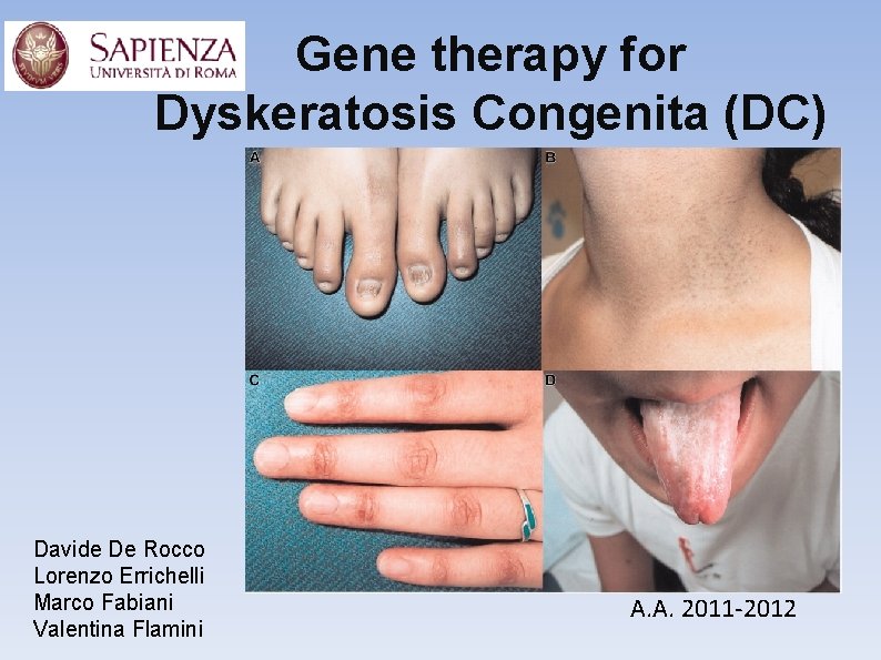 Gene therapy for Dyskeratosis Congenita (DC) Davide De Rocco Lorenzo Errichelli Marco Fabiani Valentina