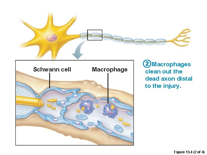 Schwann cell Macrophage 2 Macrophages clean out the dead axon distal to the injury.