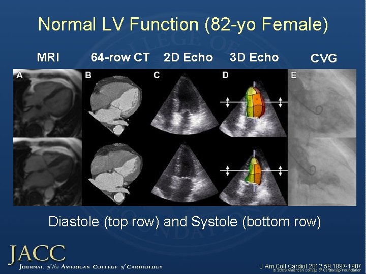 Normal LV Function (82 -yo Female) MRI 64 -row CT 2 D Echo 3