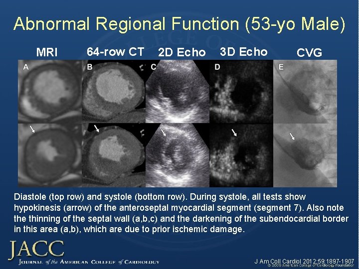 Abnormal Regional Function (53 -yo Male) MRI 64 -row CT 2 D Echo 3