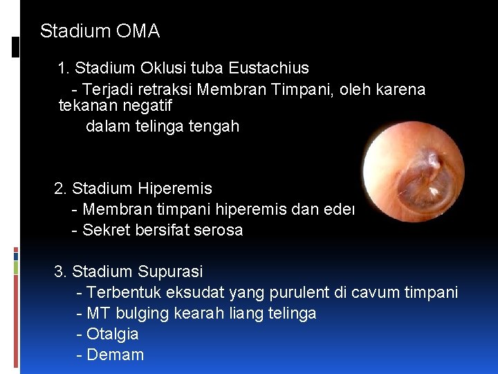 Stadium OMA 1. Stadium Oklusi tuba Eustachius - Terjadi retraksi Membran Timpani, oleh karena