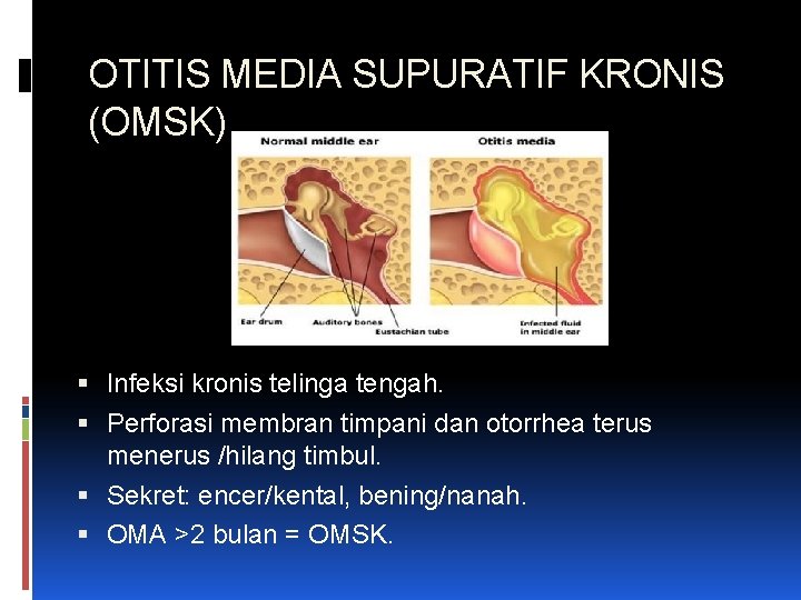 OTITIS MEDIA SUPURATIF KRONIS (OMSK) Infeksi kronis telinga tengah. Perforasi membran timpani dan otorrhea