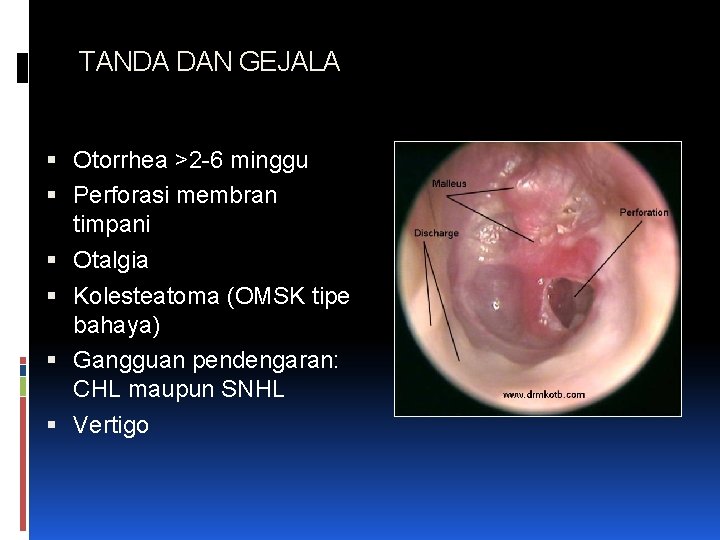 TANDA DAN GEJALA Otorrhea >2 -6 minggu Perforasi membran timpani Otalgia Kolesteatoma (OMSK tipe