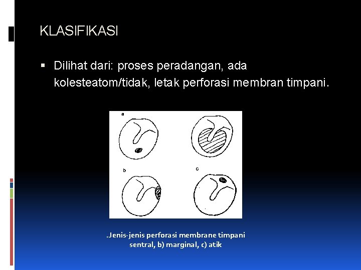 KLASIFIKASI Dilihat dari: proses peradangan, ada kolesteatom/tidak, letak perforasi membran timpani. . Jenis-jenis perforasi