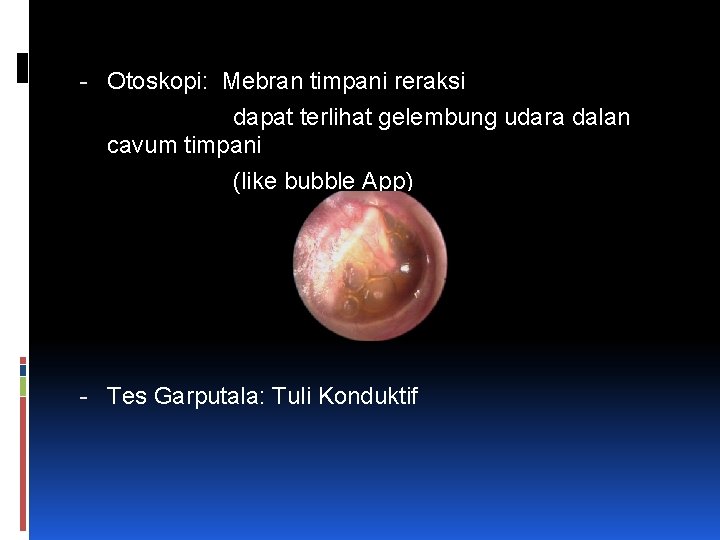 - Otoskopi: Mebran timpani reraksi dapat terlihat gelembung udara dalan cavum timpani (like bubble