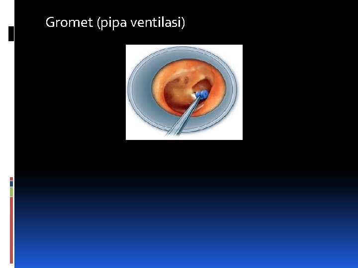 Gromet (pipa ventilasi) 