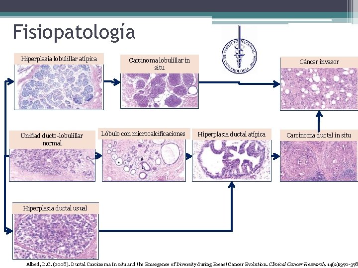 Fisiopatología Hiperplasia lobulillar atípica Unidad ducto-lobulillar normal Carcinoma lobulillar in situ Lóbulo con microcalcificaciones