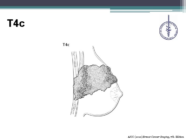 T 4 c AJCC (2010) Breast Cancer Staging, 7 th Edition 