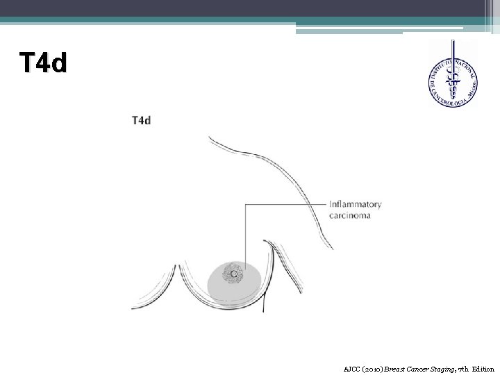 T 4 d AJCC (2010) Breast Cancer Staging, 7 th Edition 