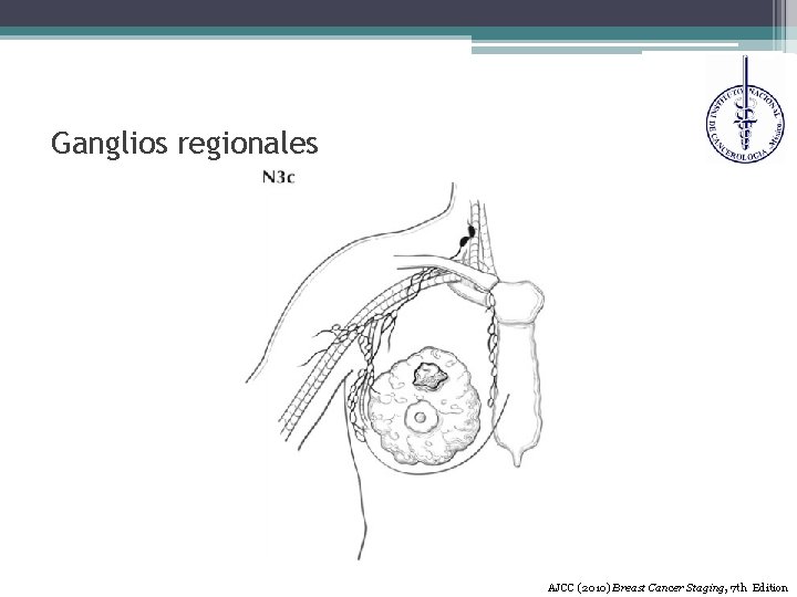 Ganglios regionales AJCC (2010) Breast Cancer Staging, 7 th Edition 