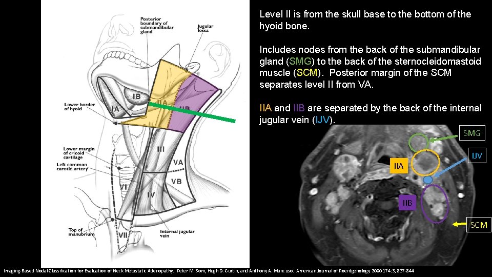 Level II is from the skull base to the bottom of the hyoid bone.