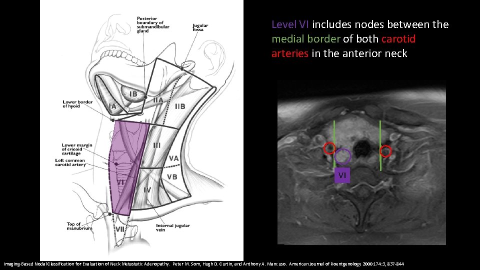 Level VI includes nodes between the medial border of both carotid arteries in the