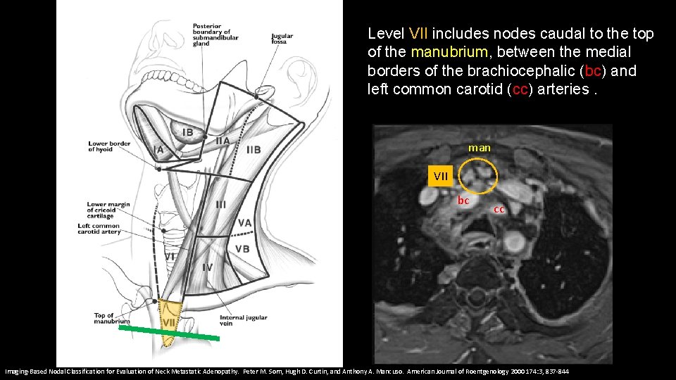 Level VII includes nodes caudal to the top of the manubrium, between the medial