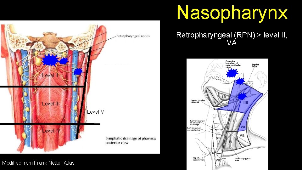 Nasopharynx Retropharyngeal (RPN) > level II, VA Level III Level V Level IV Modified