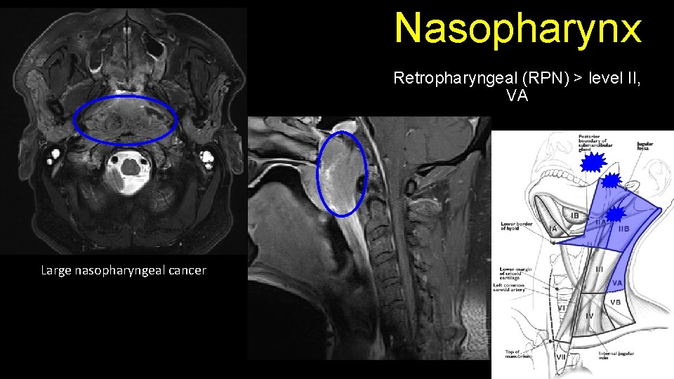 Nasopharynx Retropharyngeal (RPN) > level II, VA Large nasopharyngeal cancer 