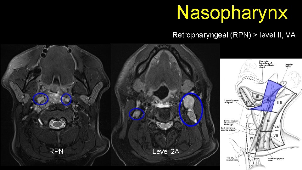 Nasopharynx Retropharyngeal (RPN) > level II, VA RPN Level 2 A 