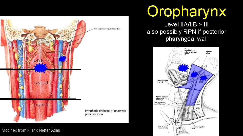 Oropharynx Level IIA/IIB > III also possibly RPN if posterior pharyngeal wall Level III