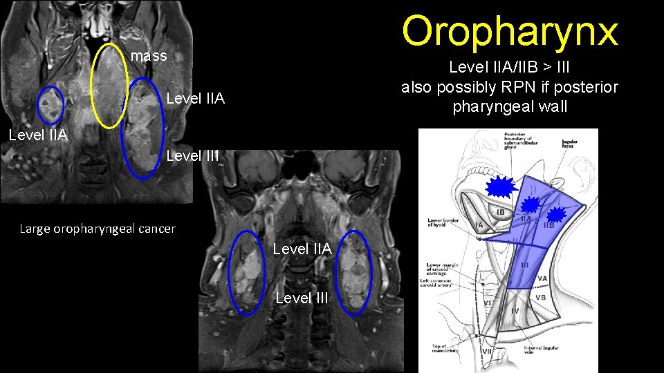 Oropharynx mass Level IIA/IIB > III also possibly RPN if posterior pharyngeal wall Level