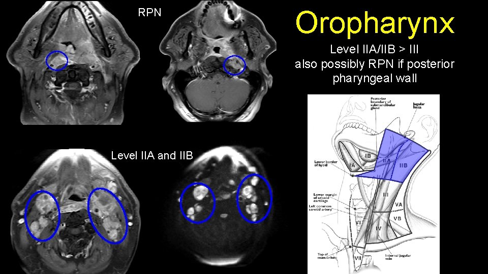 RPN Oropharynx Level IIA/IIB > III also possibly RPN if posterior pharyngeal wall Level