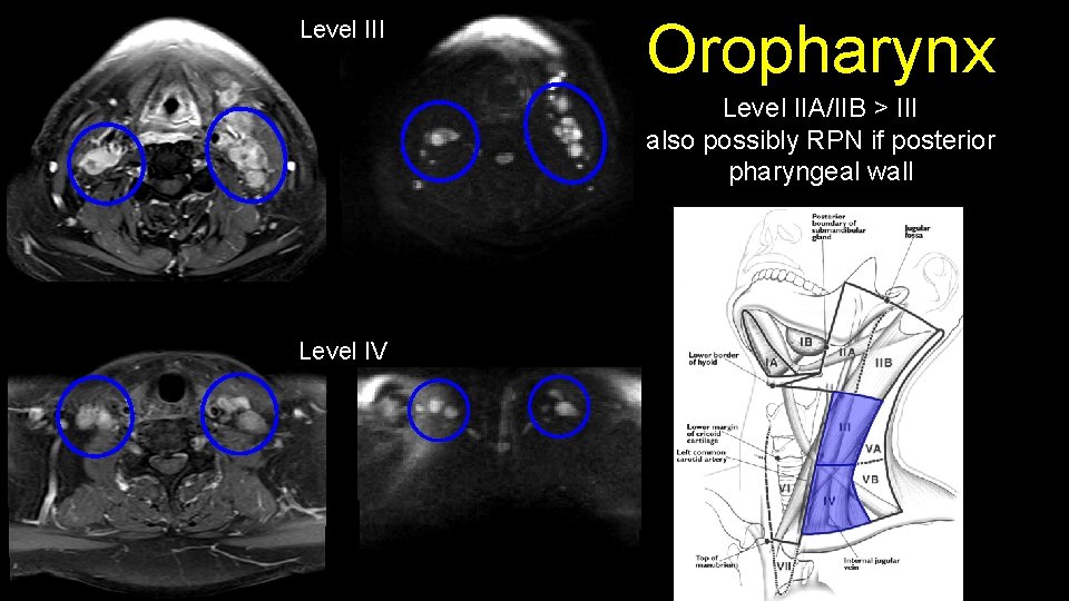 Level III Oropharynx Level IIA/IIB > III also possibly RPN if posterior pharyngeal wall