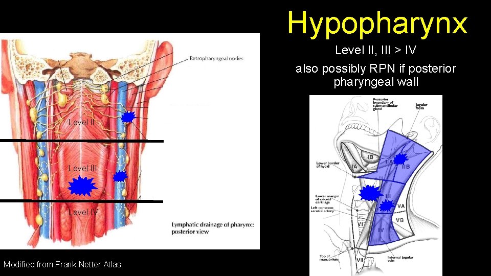 Hypopharynx Level II, III > IV also possibly RPN if posterior pharyngeal wall Level
