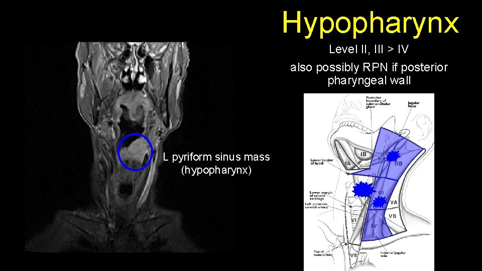 Hypopharynx Level II, III > IV also possibly RPN if posterior pharyngeal wall L
