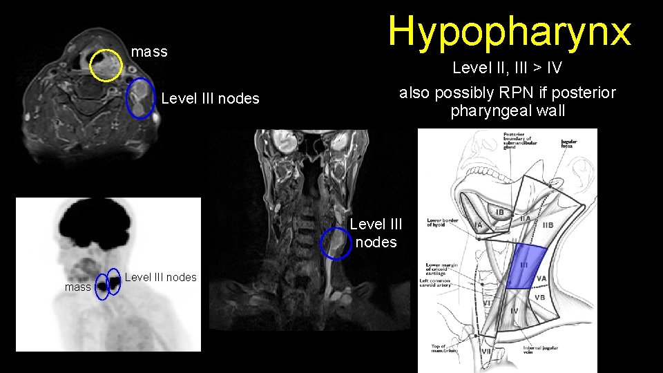 mass Level III nodes Hypopharynx Level II, III > IV also possibly RPN if