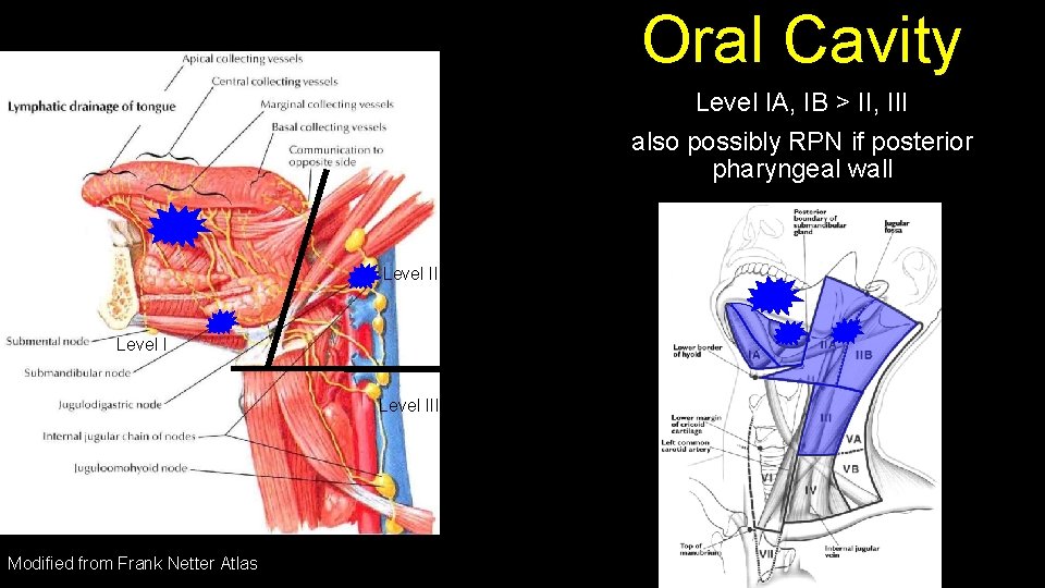 Oral Cavity Level IA, IB > II, III also possibly RPN if posterior pharyngeal