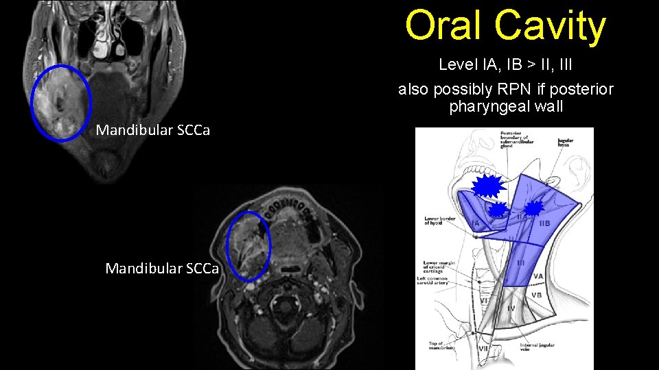 Oral Cavity Level IA, IB > II, III also possibly RPN if posterior pharyngeal