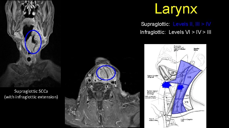 Larynx Supraglottic: Levels II, III > IV Infraglottic: Levels VI > IV > III