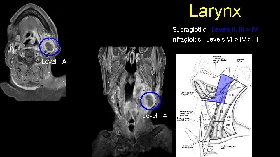 Larynx Supraglottic: Levels II, III > IV Infraglottic: Levels VI > IV > III