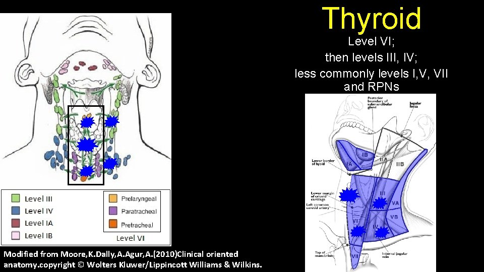 Thyroid Level VI; then levels III, IV; less commonly levels I, V, VII and
