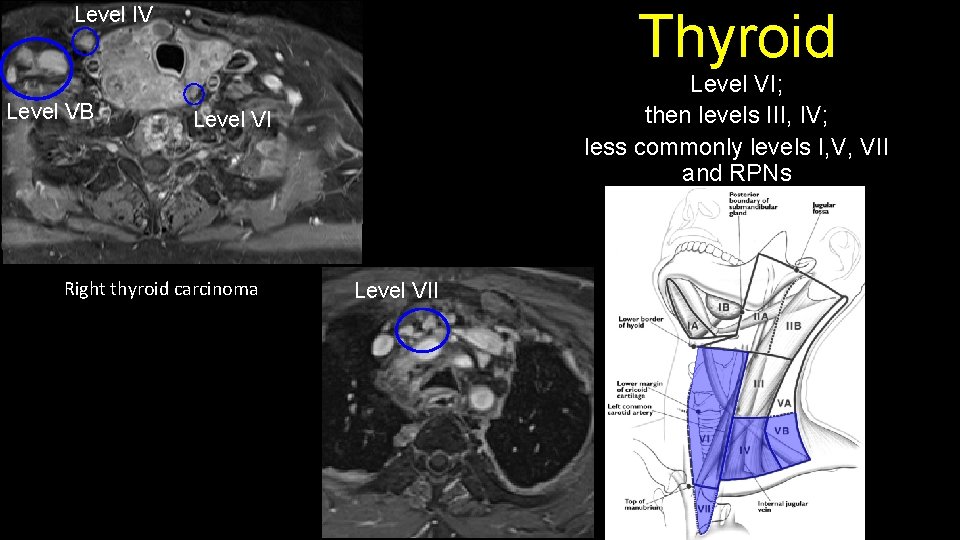 Level IV Level VB Thyroid Level VI; then levels III, IV; less commonly levels
