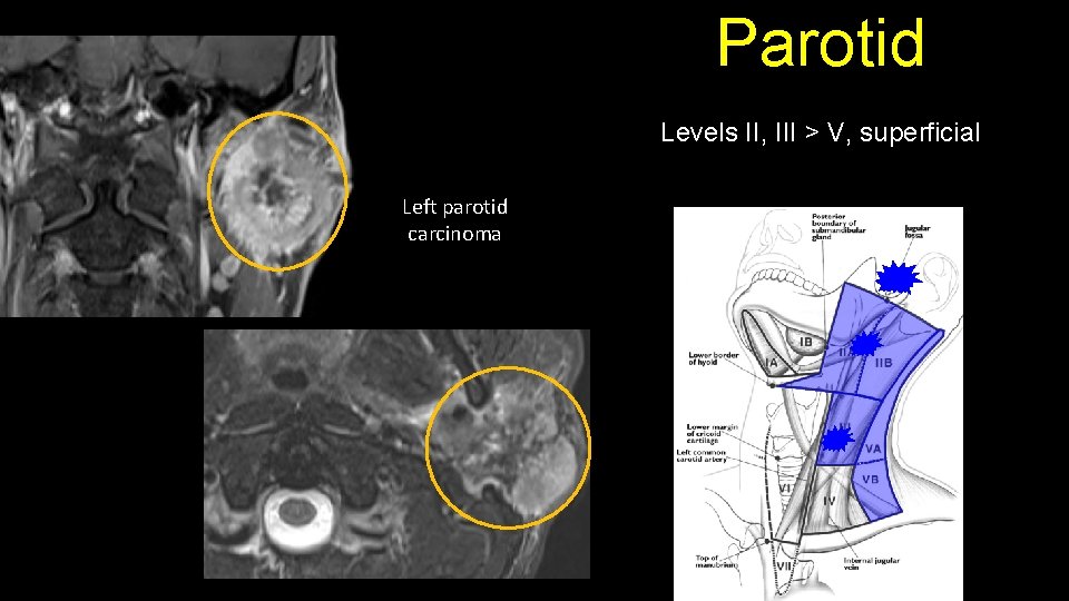 Parotid Levels II, III > V, superficial Left parotid carcinoma 