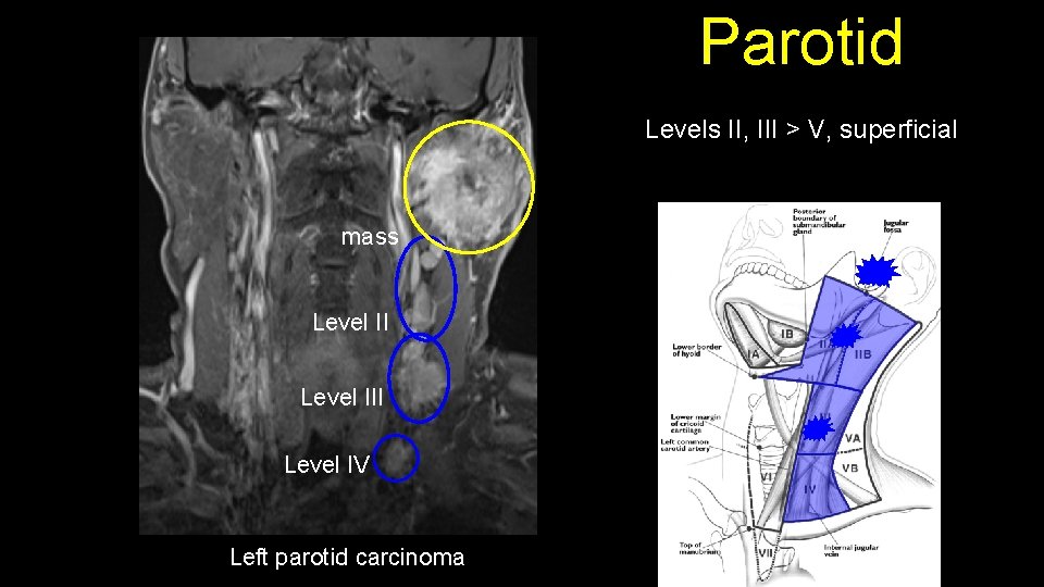 Parotid Levels II, III > V, superficial mass Level III Level IV Left parotid