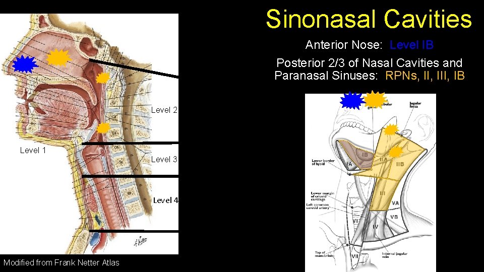 Sinonasal Cavities Anterior Nose: Level IB Posterior 2/3 of Nasal Cavities and Paranasal Sinuses: