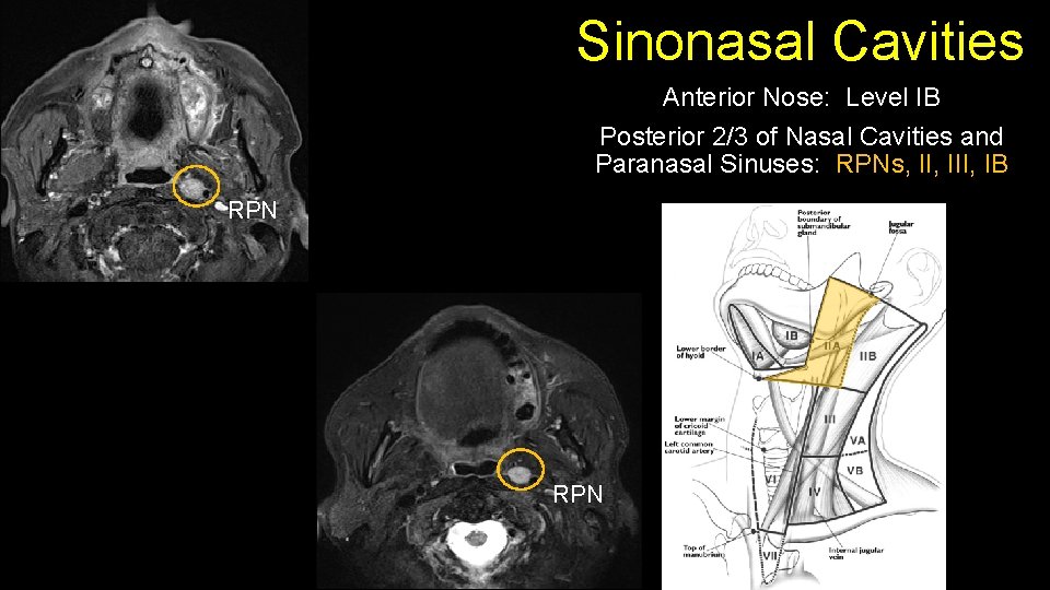 Sinonasal Cavities Anterior Nose: Level IB Posterior 2/3 of Nasal Cavities and Paranasal Sinuses: