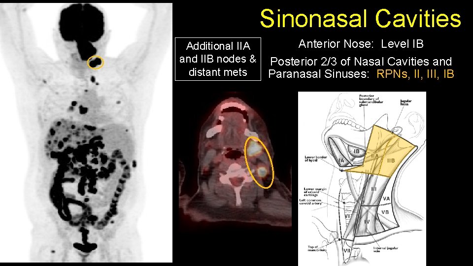 Sinonasal Cavities Additional IIA and IIB nodes & distant mets Anterior Nose: Level IB