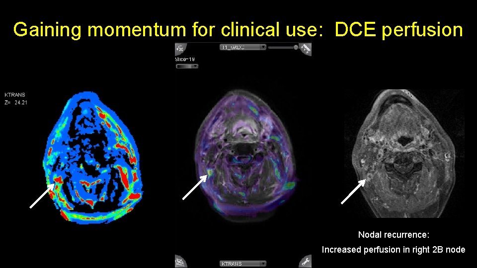 Gaining momentum for clinical use: DCE perfusion Nodal recurrence: Increased perfusion in right 2