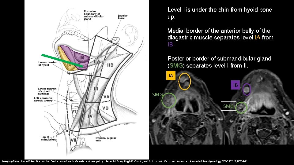 Level I is under the chin from hyoid bone up. Medial border of the