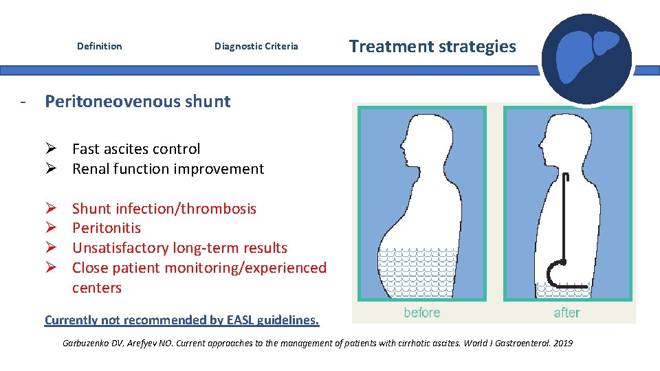 Definition Diagnostic Criteria Treatment strategies - Peritoneovenous shunt Ø Fast ascites control Ø Renal Definition Diagnostic Criteria Treatment strategies - Peritoneovenous shunt Ø Fast ascites control Ø Renal