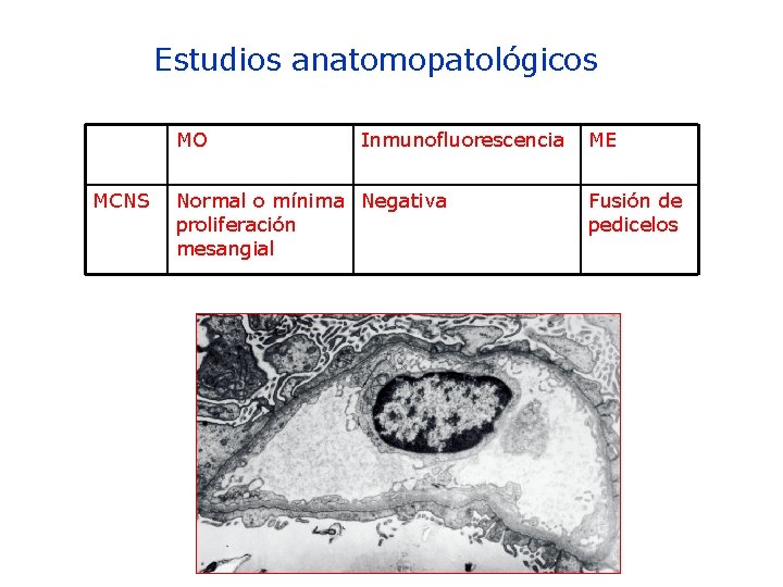 Estudios anatomopatológicos MO MCNS Inmunofluorescencia Normal o mínima Negativa proliferación mesangial ME Fusión de Estudios anatomopatológicos MO MCNS Inmunofluorescencia Normal o mínima Negativa proliferación mesangial ME Fusión de