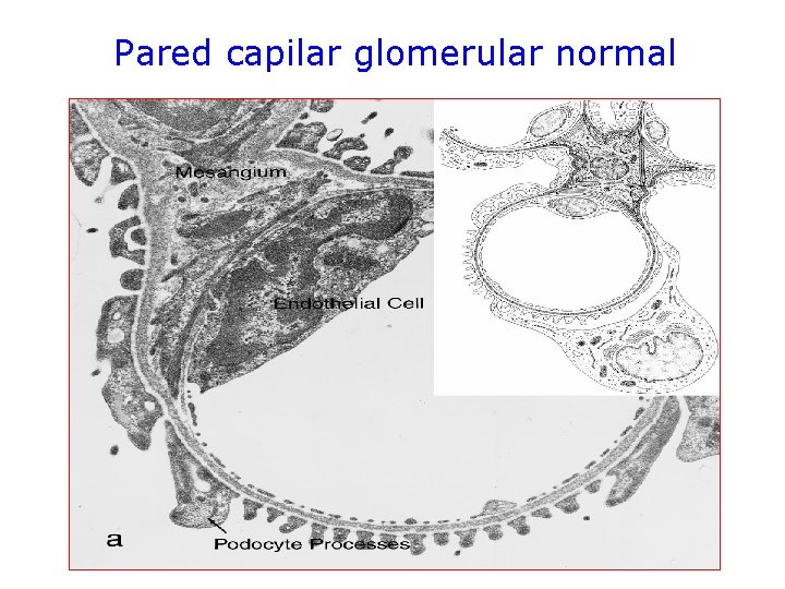 Pared capilar glomerular normal 