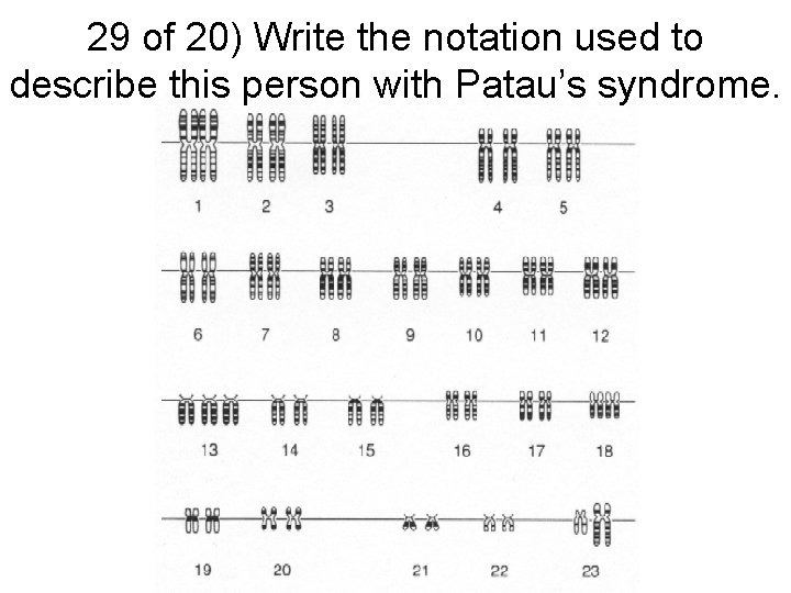 29 of 20) Write the notation used to describe this person with Patau’s syndrome.