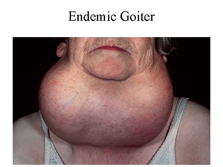 Endemic Goiter 