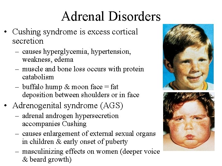 Adrenal Disorders • Cushing syndrome is excess cortical secretion – causes hyperglycemia, hypertension, weakness,
