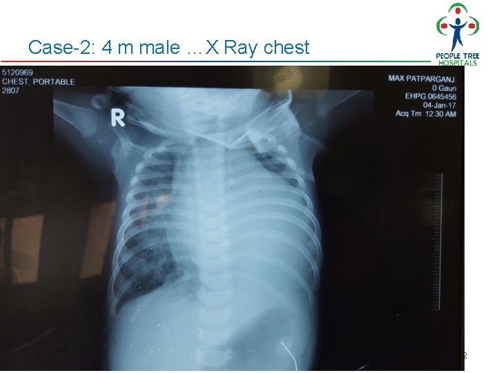 Case-2: 4 m male …X Ray chest 9/9/2020 Pedicon 2017: L N Taneja 52 Case-2: 4 m male …X Ray chest 9/9/2020 Pedicon 2017: L N Taneja 52